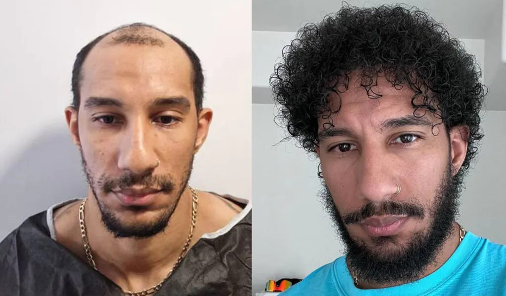 Afro Hair Transplant in Turkey