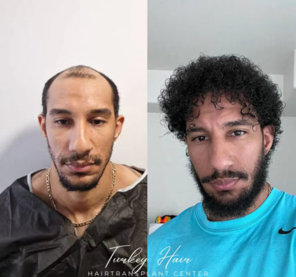 Afro Hair Transplant in Turkey